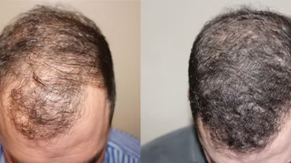 hair loss doctor New Jersey