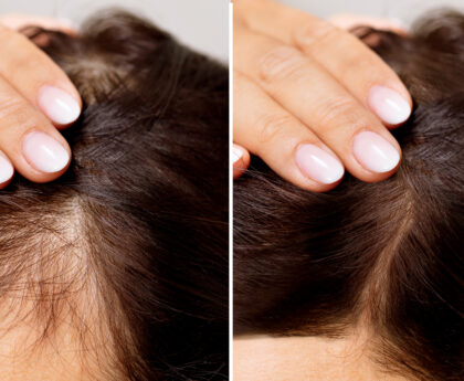 New Jersey hair loss treatment