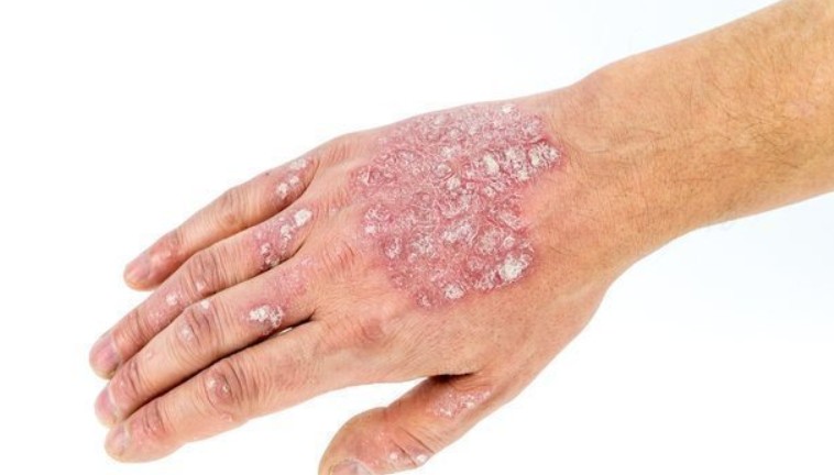 basal cell carcinoma treatment costa mesa ca